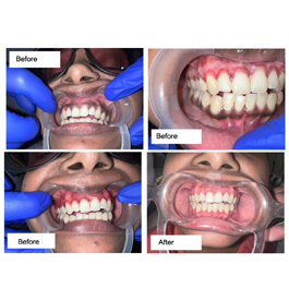 before-after-small-1 