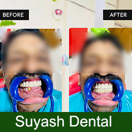 before-after-small-1 