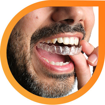 braces-aligners-img-2