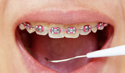 braces-aligners-img-3