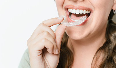braces-aligners-img-4